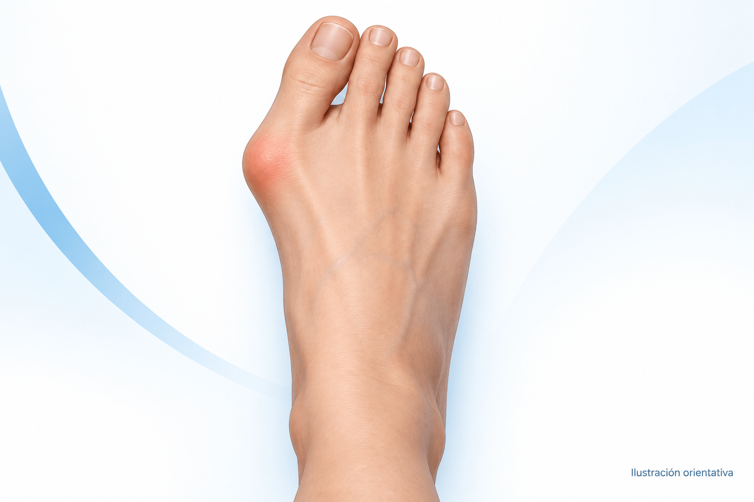 Ilustración de un pie con juanete o hallux valgus
